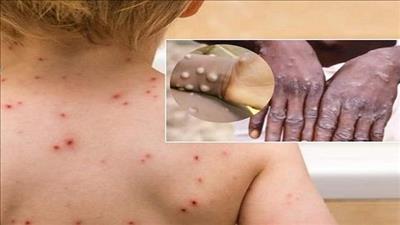 Bệnh đậu mùa khỉ không còn là tình trạng khẩn cấp về y tế công cộng