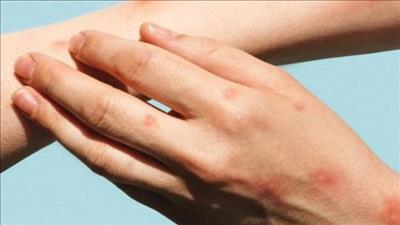 Cẩn trọng trong phòng, chống bệnh đậu mùa khỉ khi phát hiện ca mắc mới