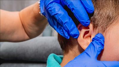 Những ảnh hưởng mà SARS-CoV-2 có thể gây ra cho thính lực của bạn