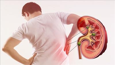 Những nguyên nhân gây suy thận ít người biết